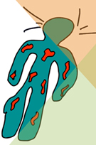 psoriasi