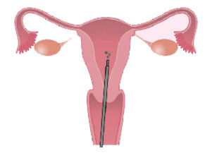 inseminazione mediante sottile catetere intrauterino